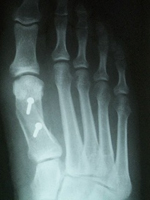 X-ray image of a foot treated for hallus valgus bunion